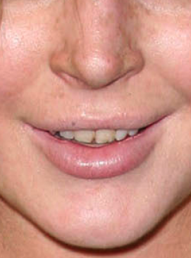 lindsay-lohan-teeth_271x366.png